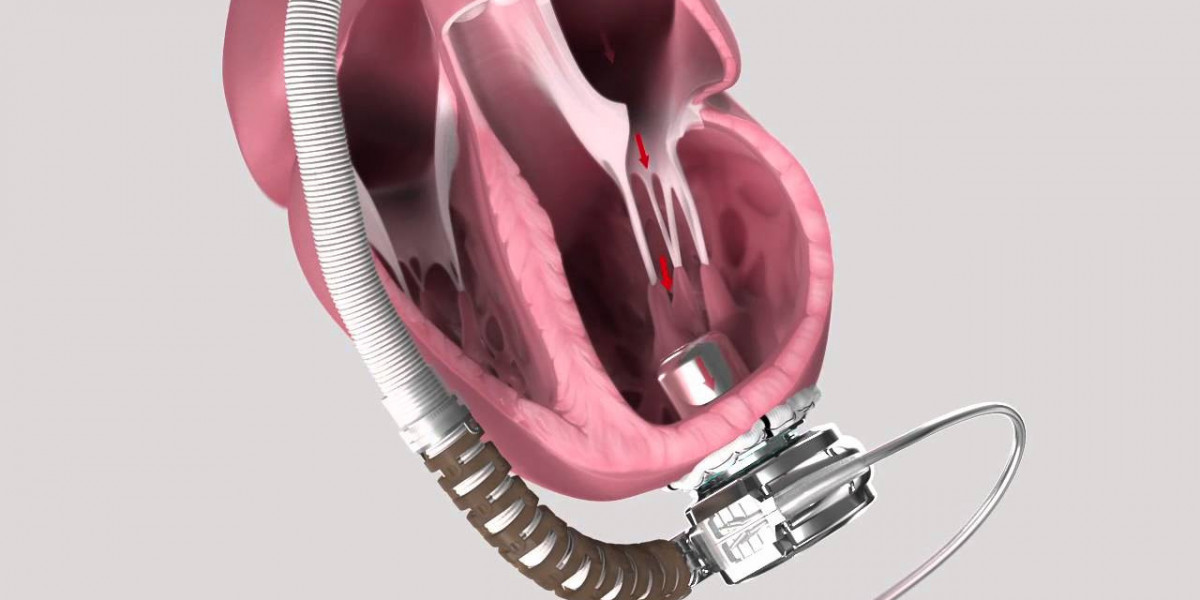 Heart Pump Devices Market Size Prognosticated To Perceive A Thriving Growth; MRFR Unleashes Industry Insights