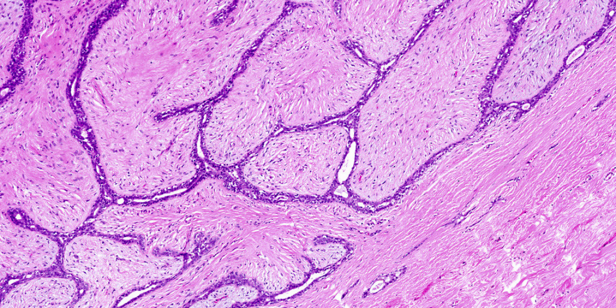 Fibroadenoma Market Players Outcomes & Perspectives